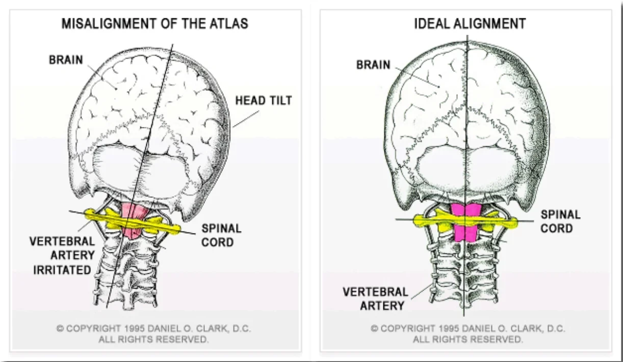misalignment of the atlas